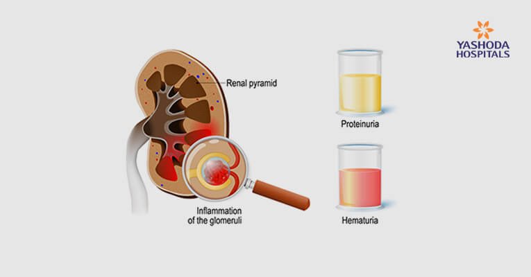 Diagnosis-of-glomerulonephritis